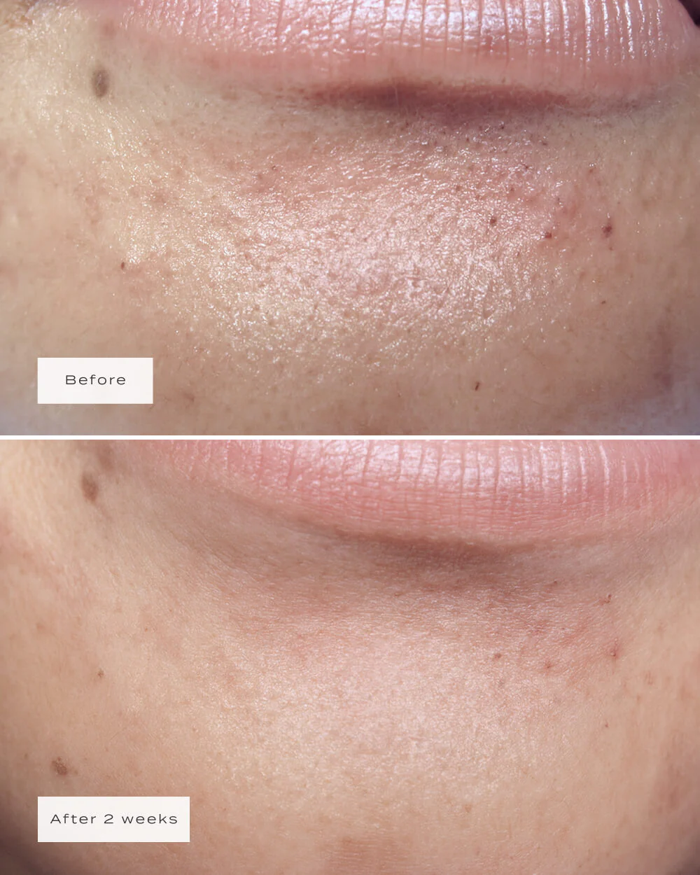 CHIN PATCHES - Image 4