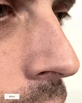 NOSE PATCHES - Image 5